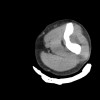 SPORK, NICO - 22.03.1976 - 02.08.2022 - CT obere Extremität - 17:56:57